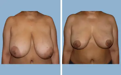 Before and After